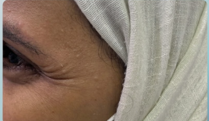 قبل علاج البشرة