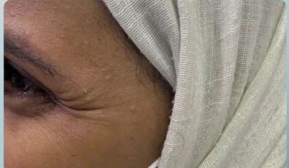 قبل علاج البشرة في مجمع أيار السابع الطبي جازان