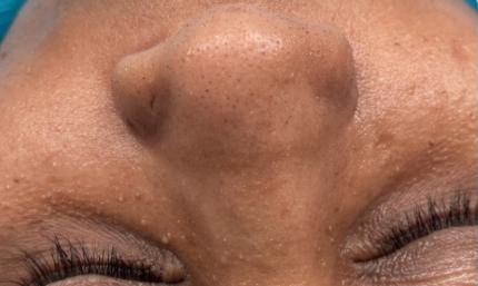 بعد الجراحة التجميلية