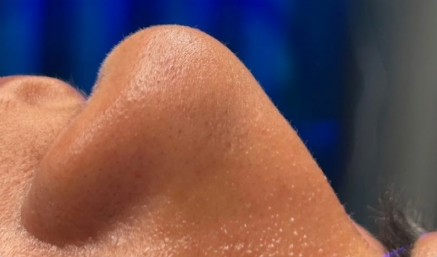 قبل تجميل الأنف