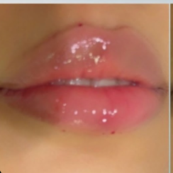 بعد فيلر الشفاه