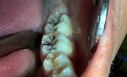 قبل علاج الأسنان