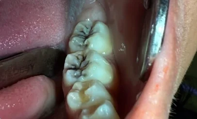قبل علاج الأسنان في مجمع أيار السابع الطبي جازان